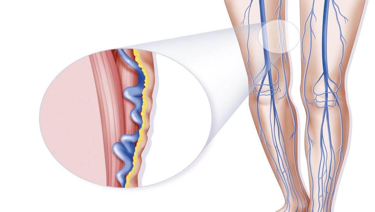 Causas de las venas varicosas